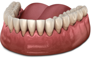 gum recession graphic