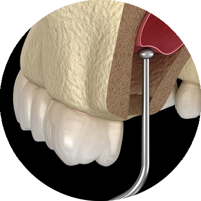 3d model of sinus lift