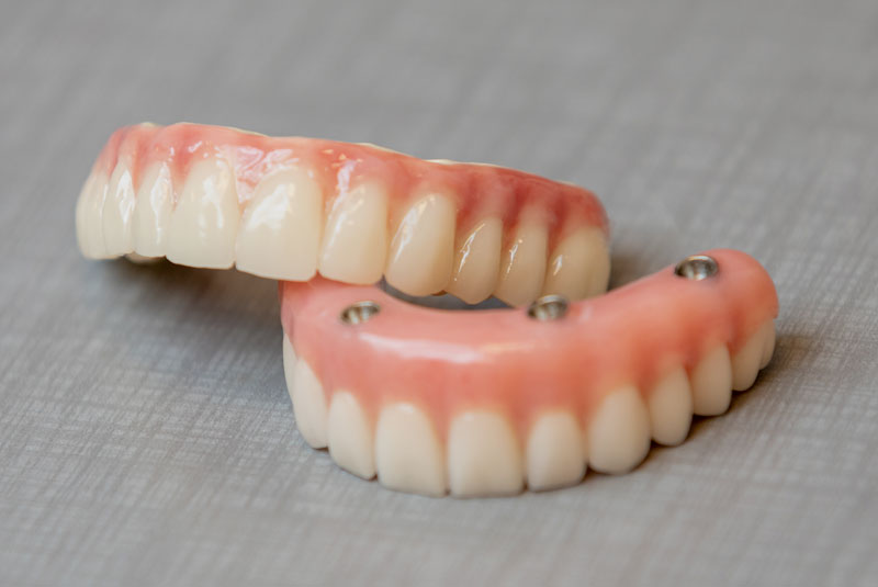 dental implant model on counter