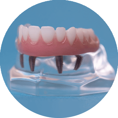 full mouth dental implant model on counter