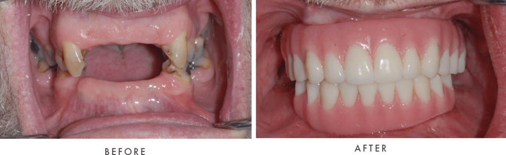 Full Mouth Dental Implants