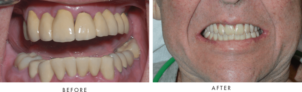 case bessolo full arch implants combined