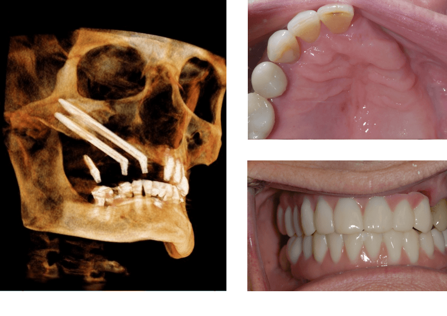 case budros zygomatic implants combined
