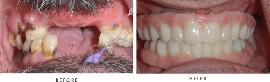 case mcninch full arch implants combined