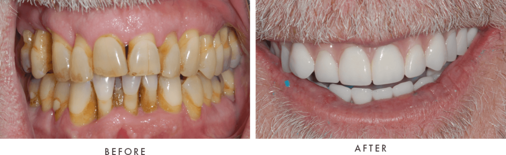 case ritter full arch implants combined