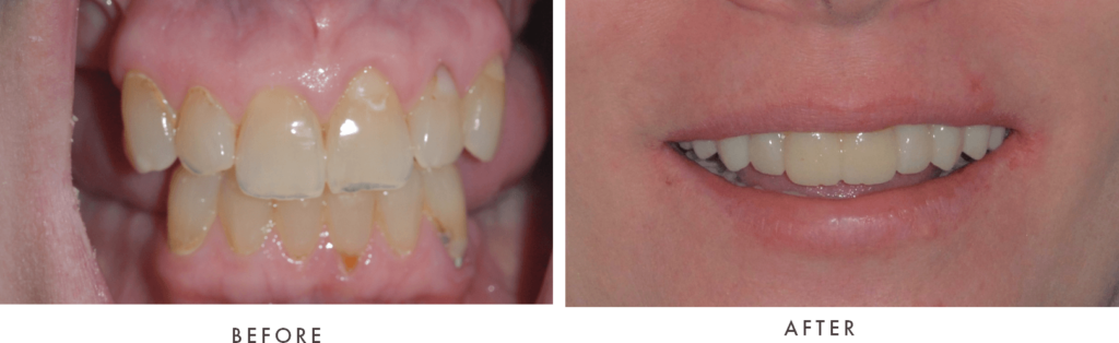 case silver full arch implants combined
