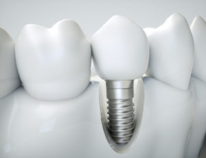 Dental implants example model