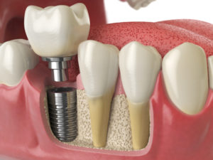 Dental implants example model