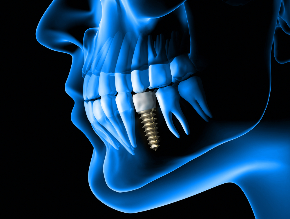 Dental implant xray