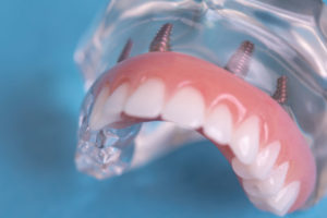 Full mouth dental implants example model