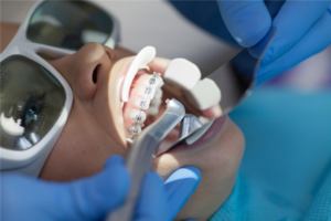 Patient opening mouth with braces