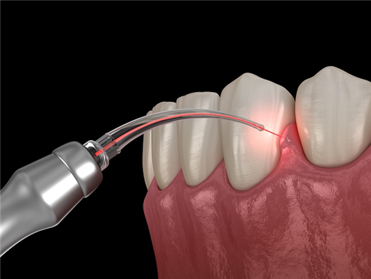 Laser gum surgery example model