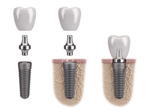 Dental implant example model