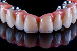 full arch dental implants